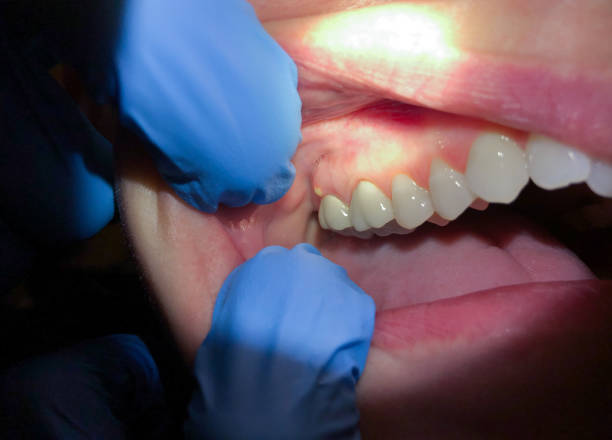 Best Emergency Wisdom Teeth Removal in Detroit, MI